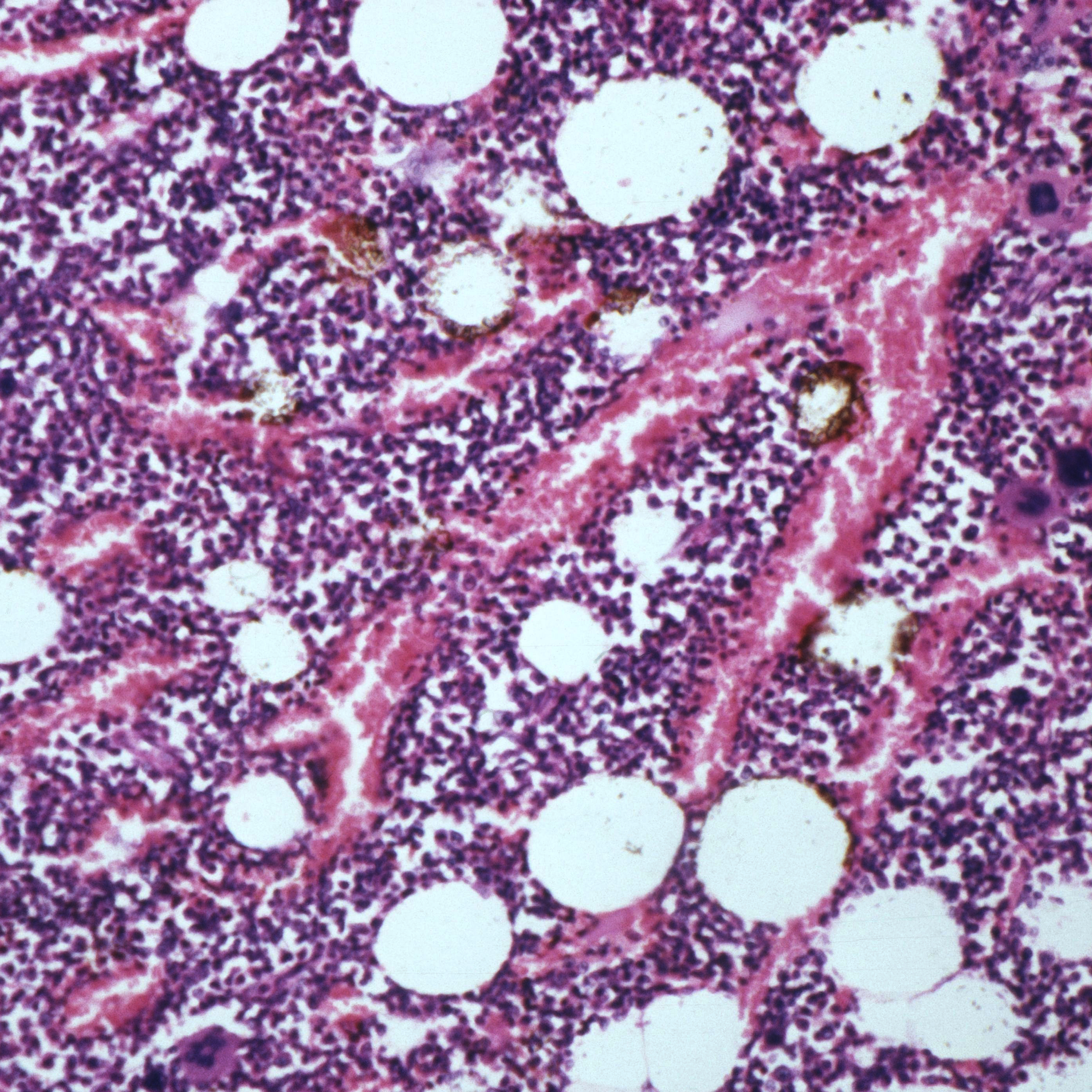 Stem Cell Transplantation for AIDS-related Lymphoma